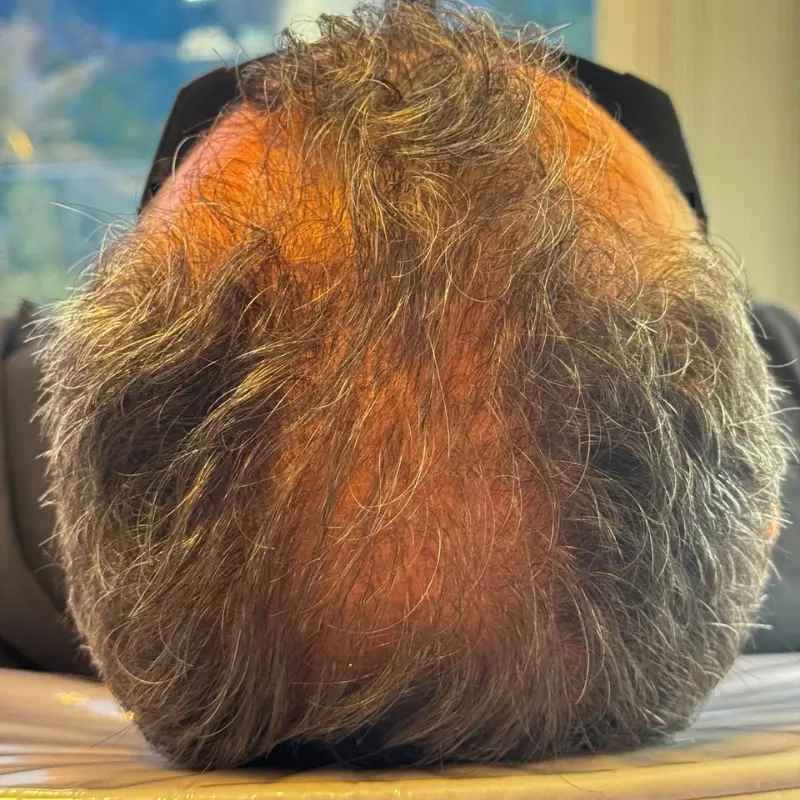 Início — Alopecia Androgenética (calvície)