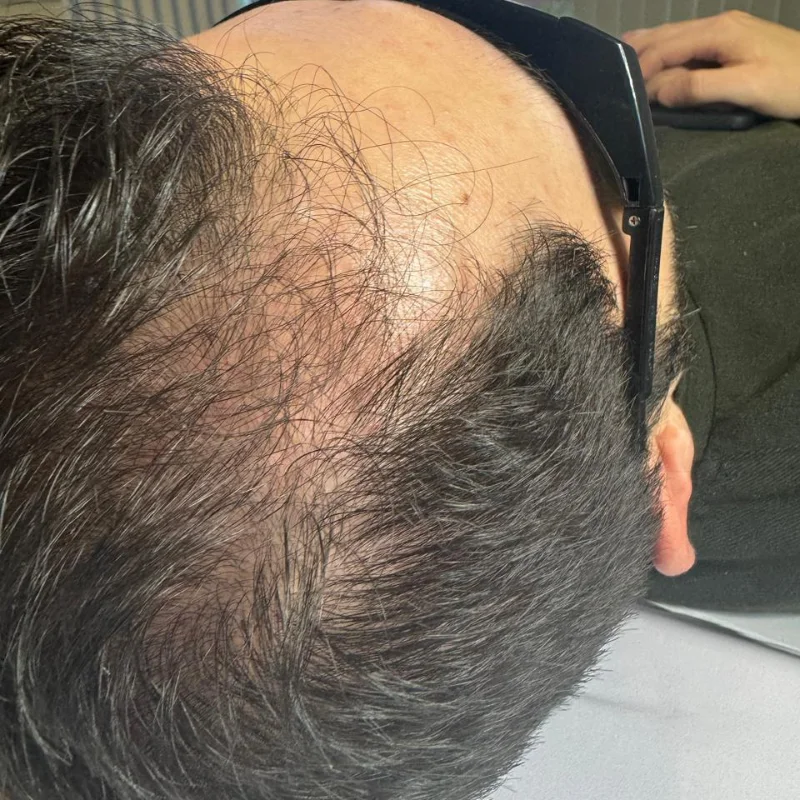 Início — Alopecia Androgenética — Região bitemporal