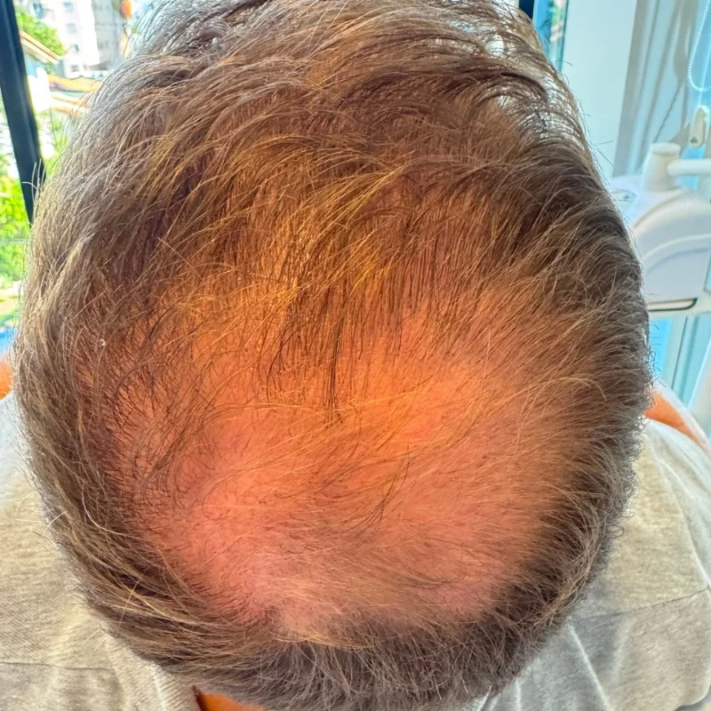 Início — Alopecia Androgenética — Região da coroa
