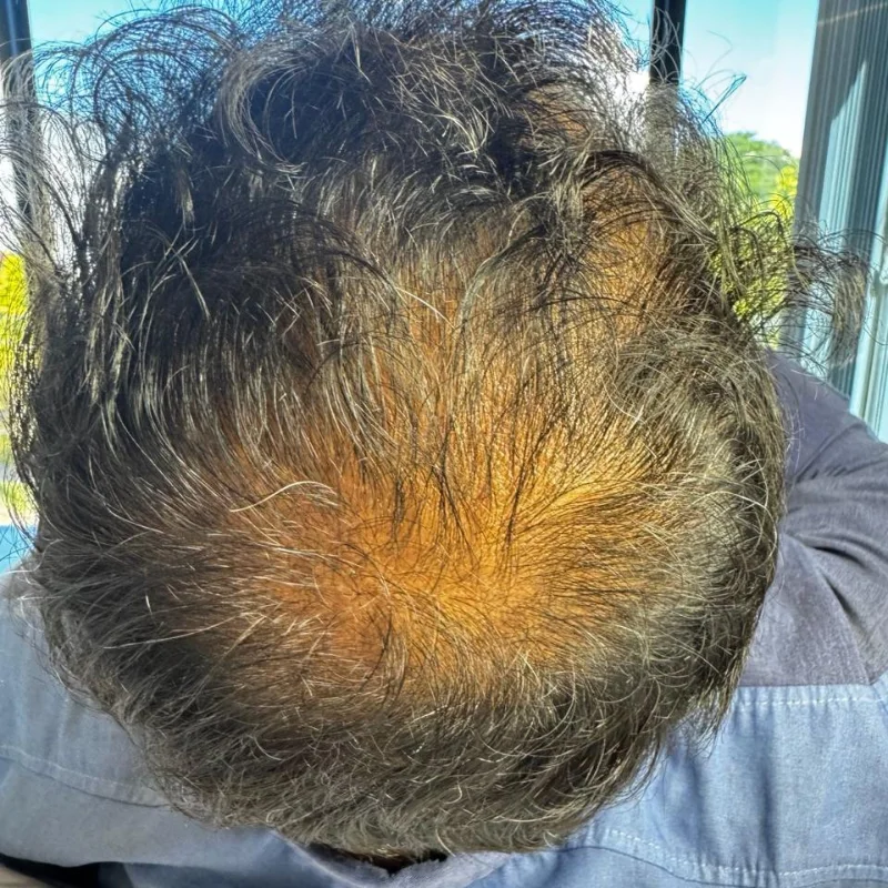 Início — Alopecia Androgenética — Evolução