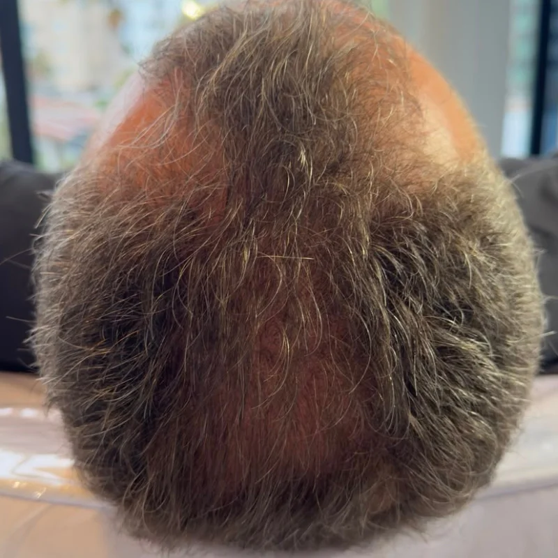 Evolução — Alopecia Androgenética (calvície)