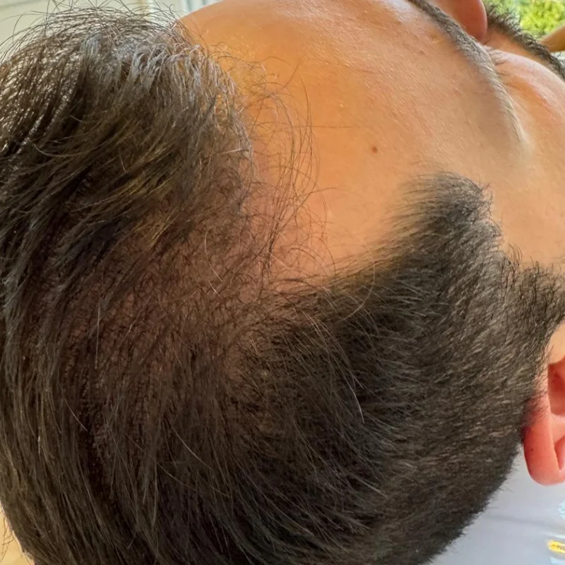 Evolução — Alopecia Androgenética — Região bitemporal