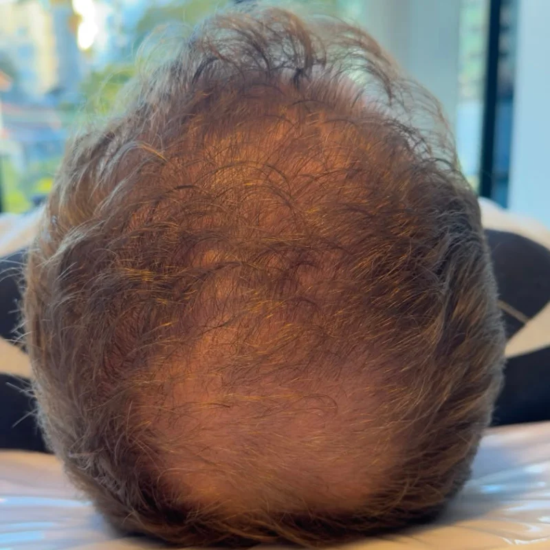 Evolução — Alopecia Androgenética — Região da coroa