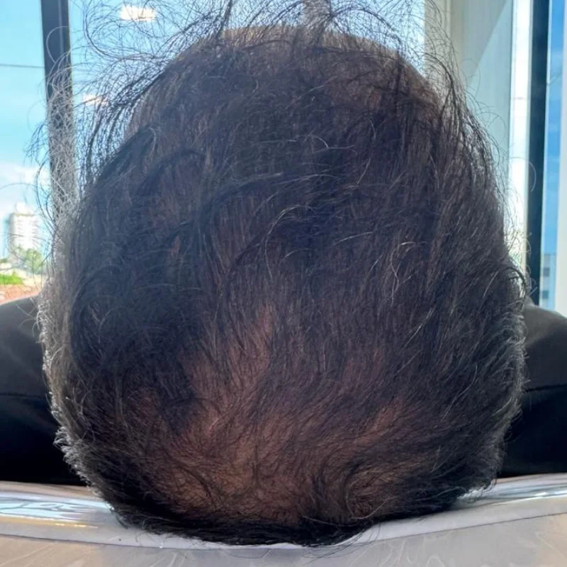 Evolução — Alopecia Androgenética — Evolução